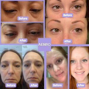 NewEye™Pro | Eyebag Removal Device (🔥Hot Sale 59% OFF) - Emporium Shop